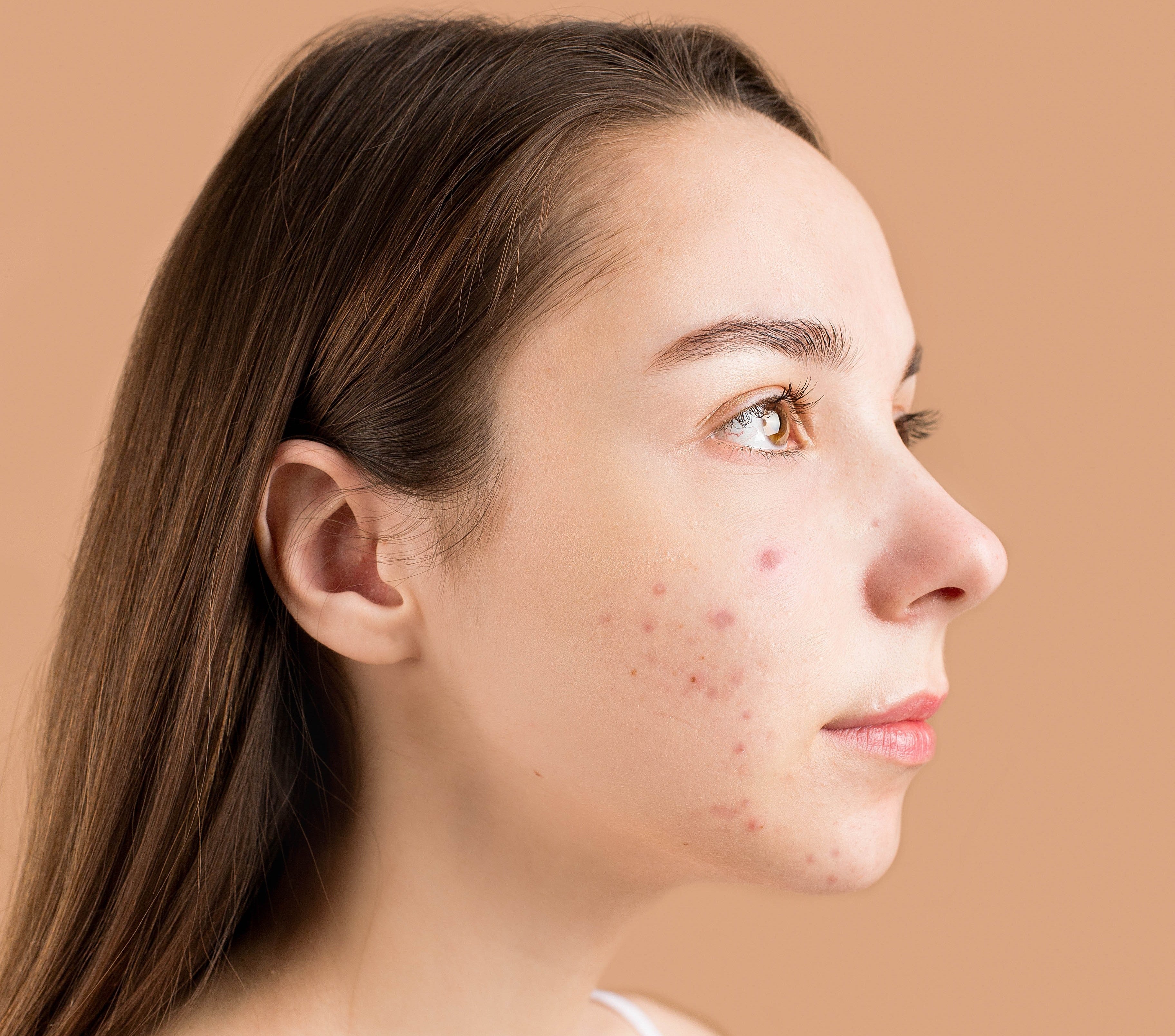 How to Get Rid of Acne Scars Once and For All